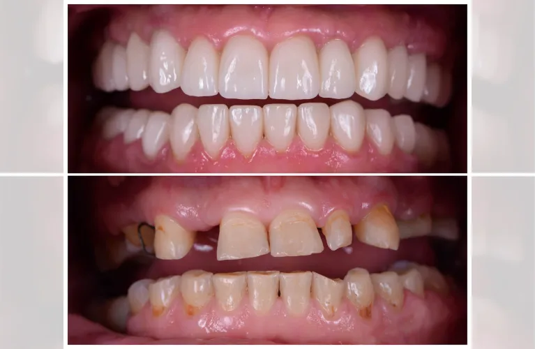 Full Mouth Rehabilitation